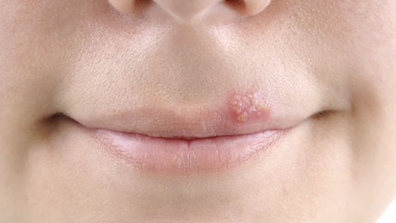 heridas en la boca herpes
