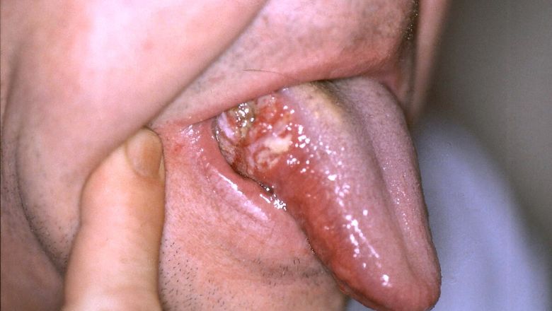 heridas en la boca por quimioterapia