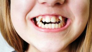 maloclusión dental