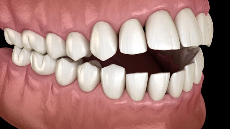 maloclusió dental classe 1