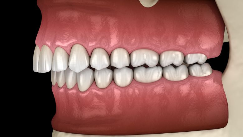 maloclusió dental classe 2