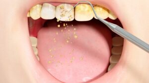 sarro dental extremo