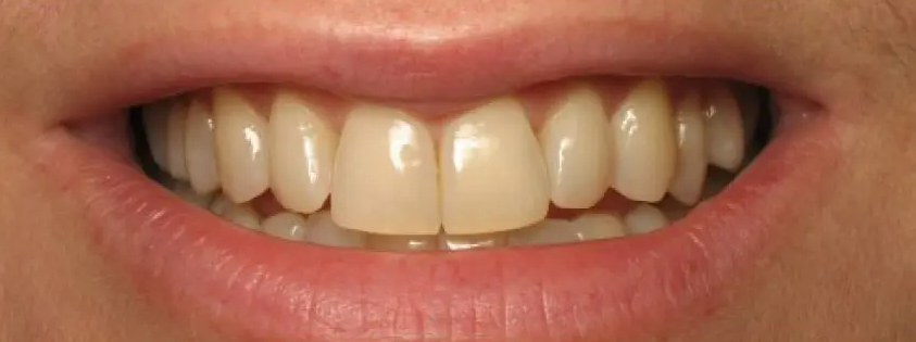 blanqueamiento dental antes