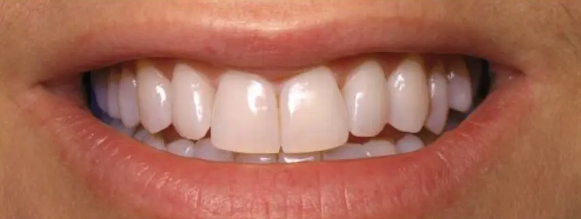 blanqueamiento dental despues