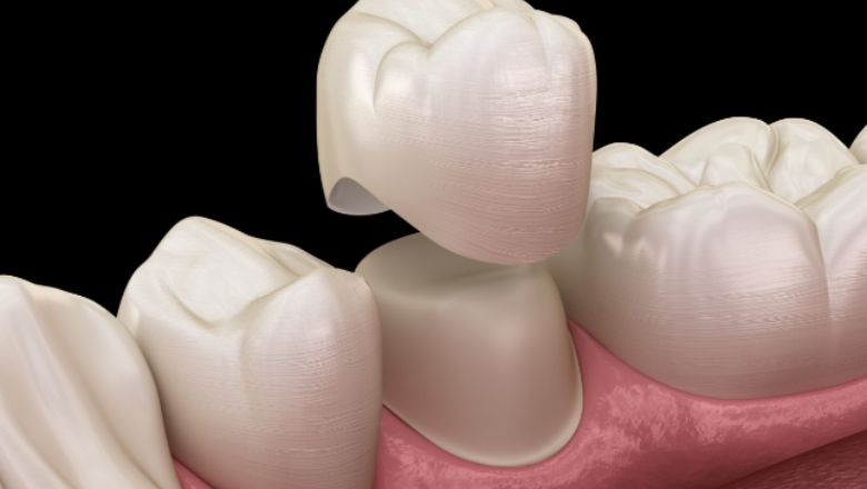 dentadura fixa corona dental