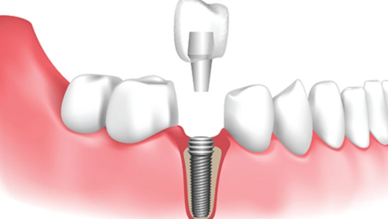 dentadura postissa fixa amb implants dentals
