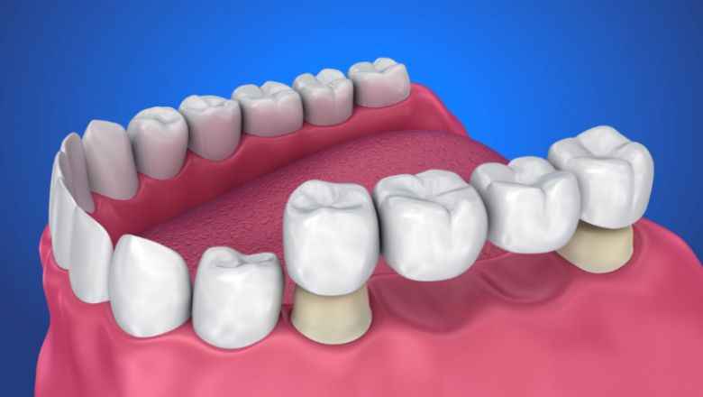 ponts dentals