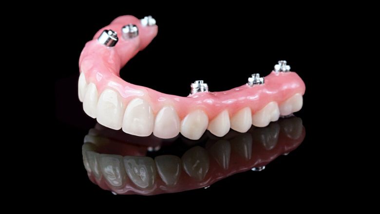 dentadures postisses fixes