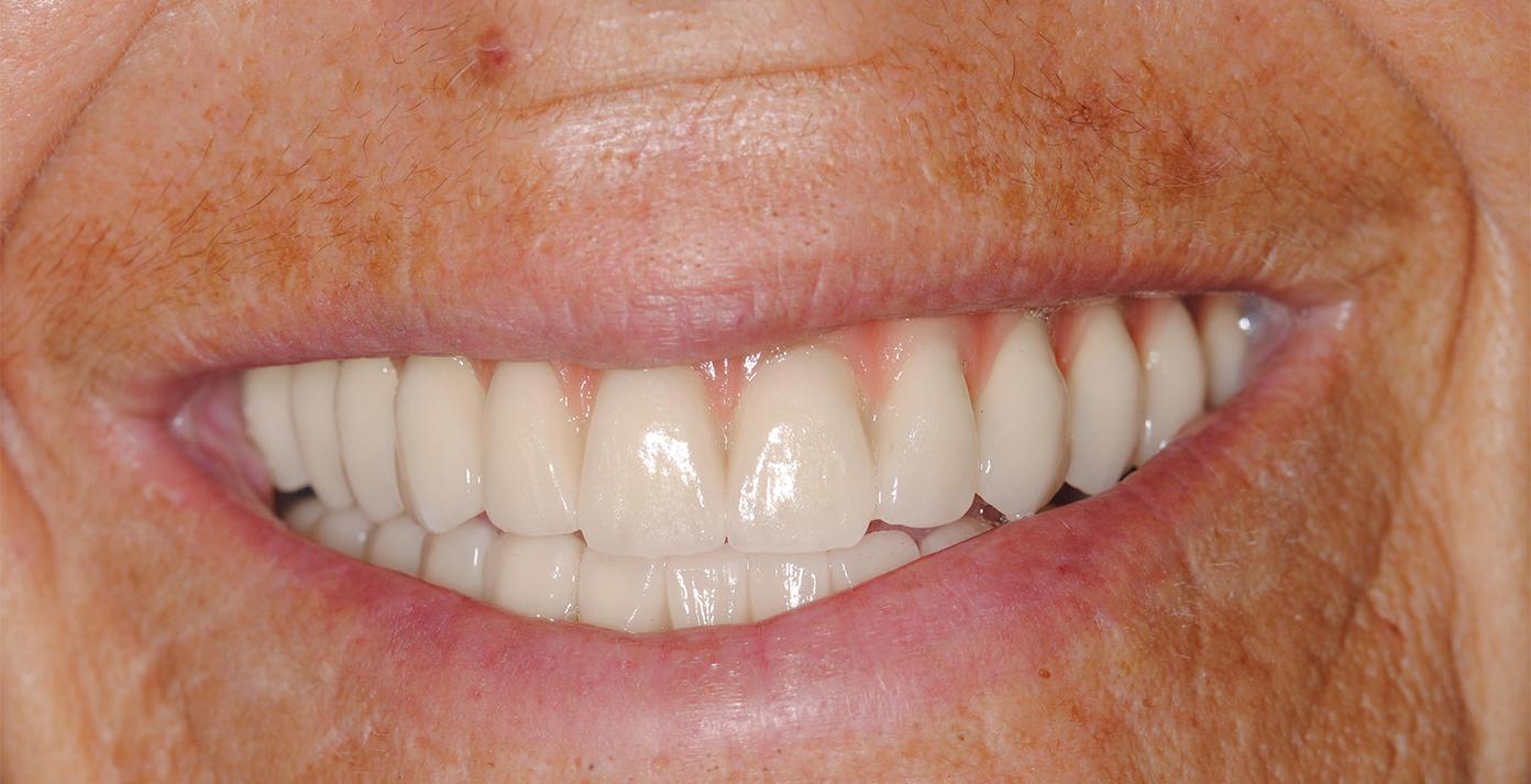 despues del tratamiento dental