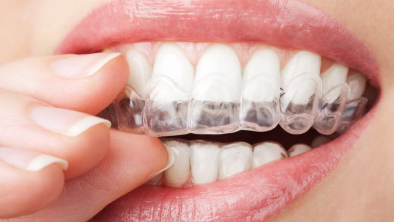 retenenidor dental 