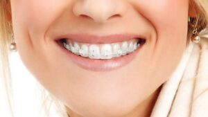 Brackets de zafiro