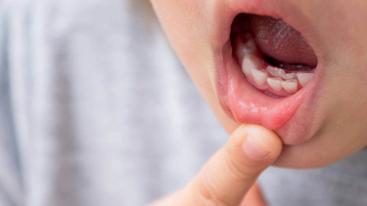 Dientes dobles