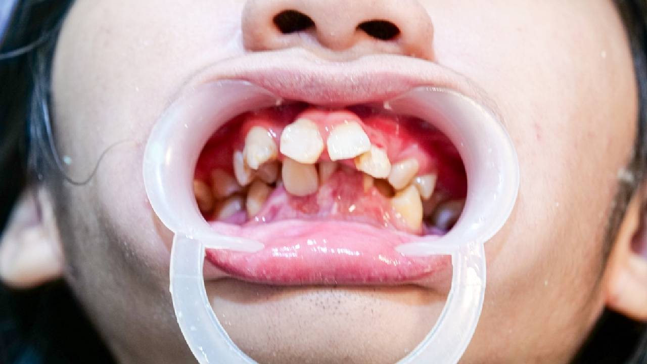 Espacios o apiñamientos en los dientes temporales