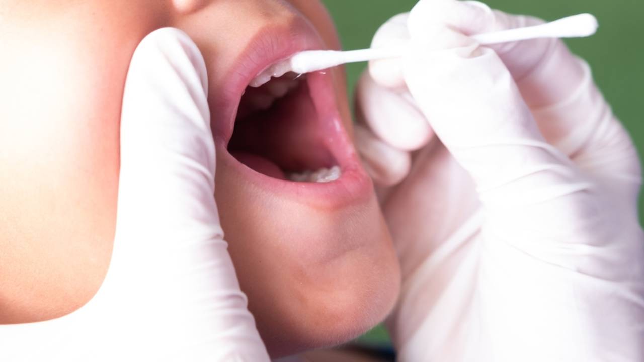 Fluorización en niños