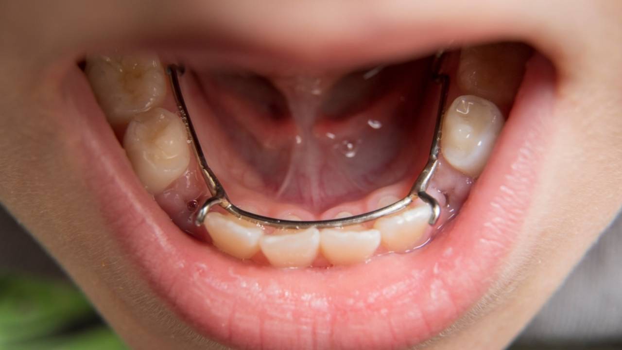 Mantenedores de espacio dentales
