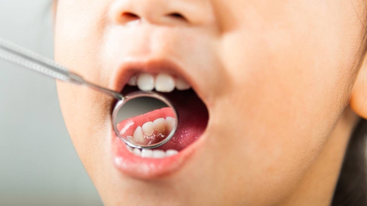 Obturaciones o empastes dentales en niños