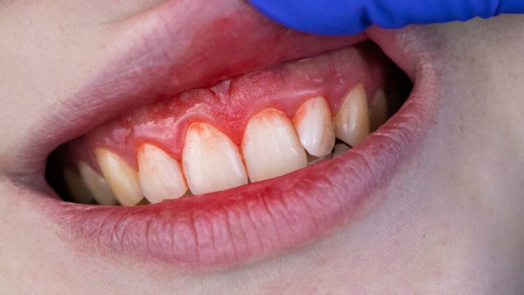 Periodontitis: causas, síntomas y cómo prevenir esta enfermedad bucal