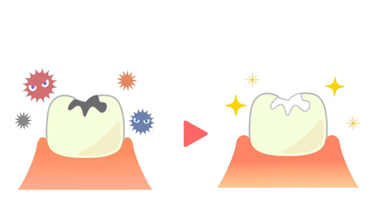 Selladores dentales  para niños