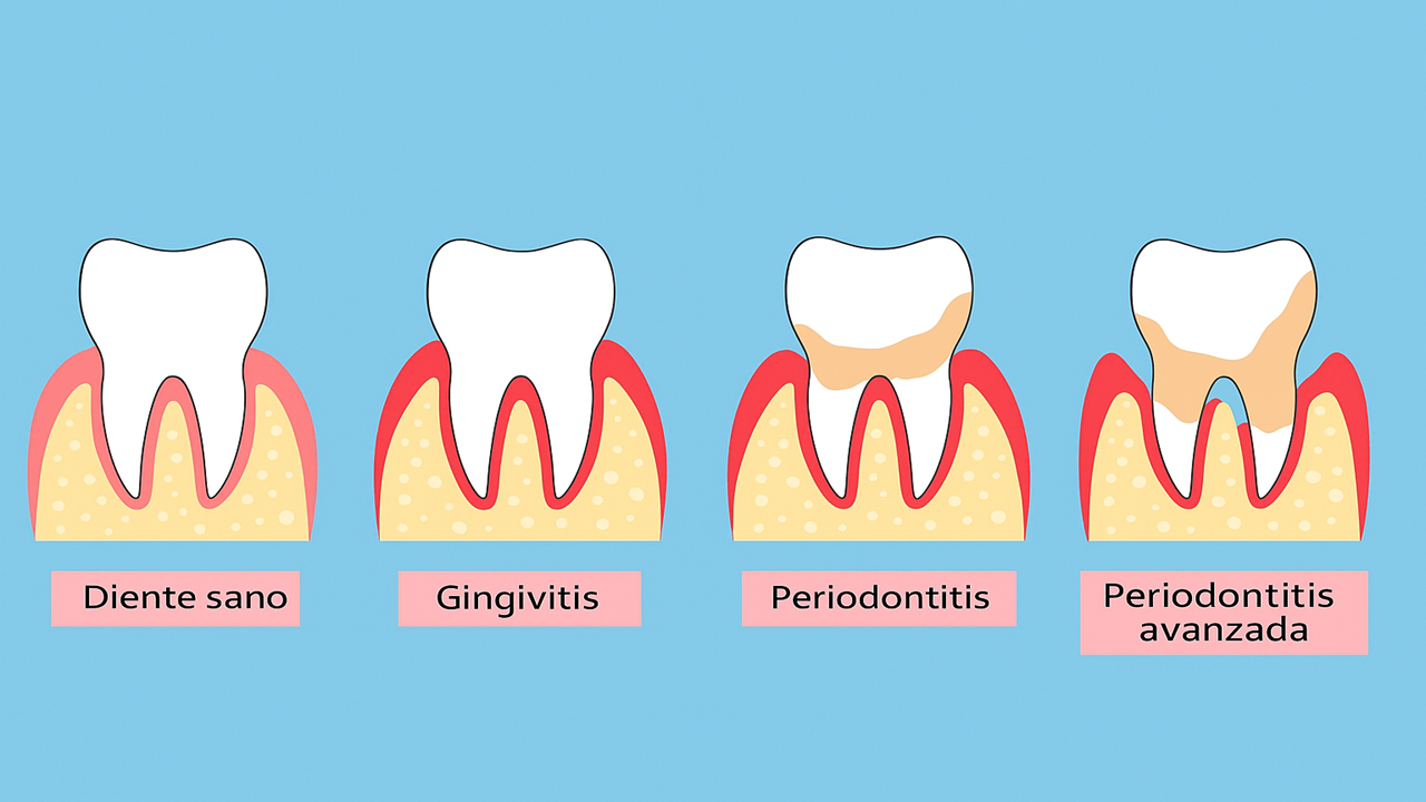 Qué es la periodontitis y sus fases