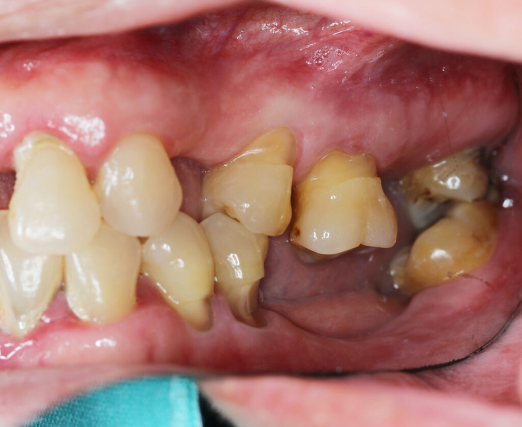 Abfracción dental ¿Por qué ocurre y qué tratamientos existen?