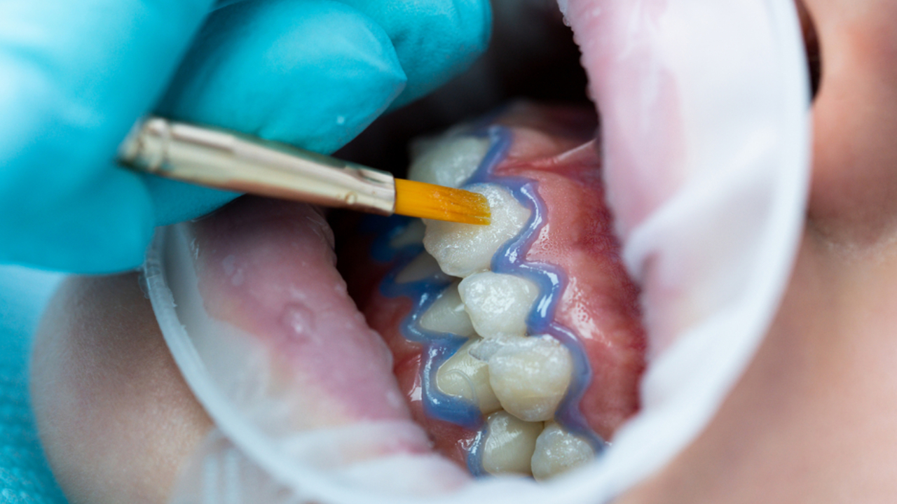 Blanqueamiento dental