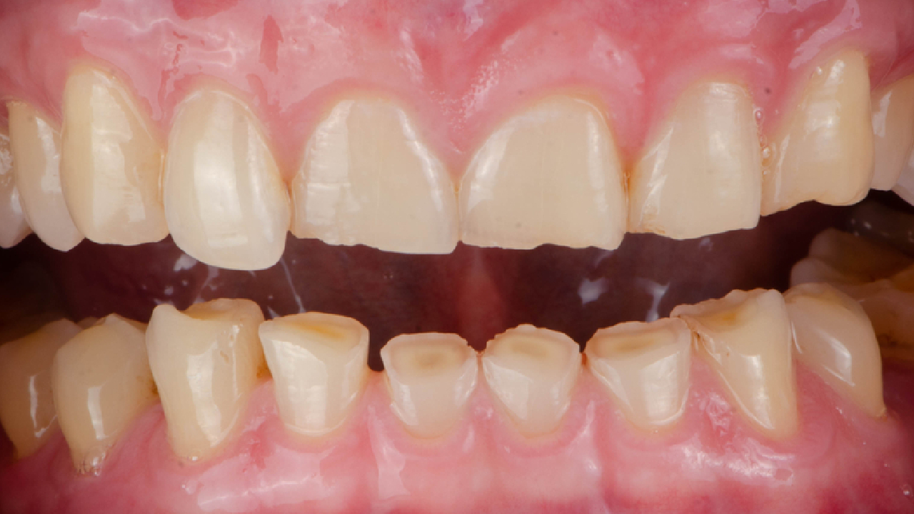 Desgaste en los dientes