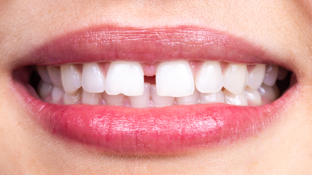 Diastema