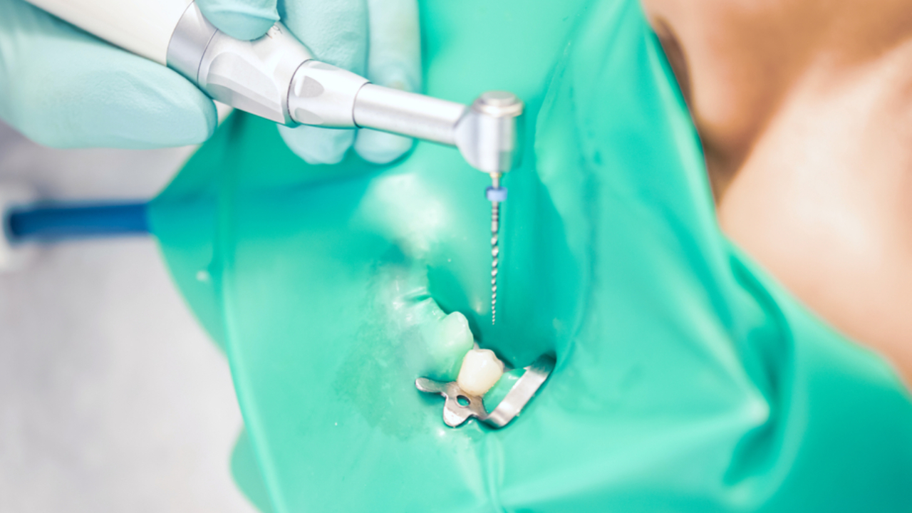 Endodoncia unirradicular: en qué casos se recomienda y cuál es su procedimiento