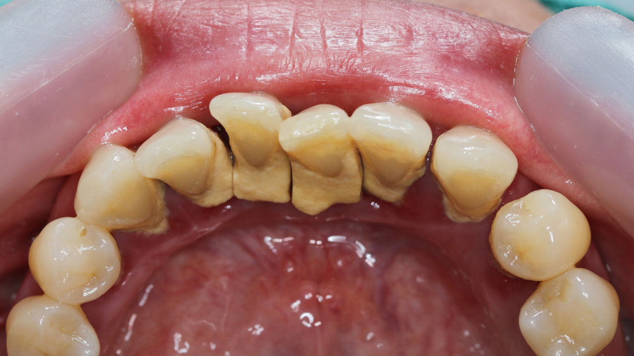 Enfermedades en los dientes o encías