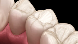 Resina preventiva: cómo proteger tus dientes de las caries