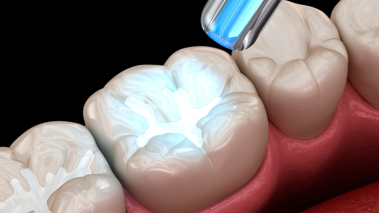 ¿Cómo se aplica la resina preventiva?