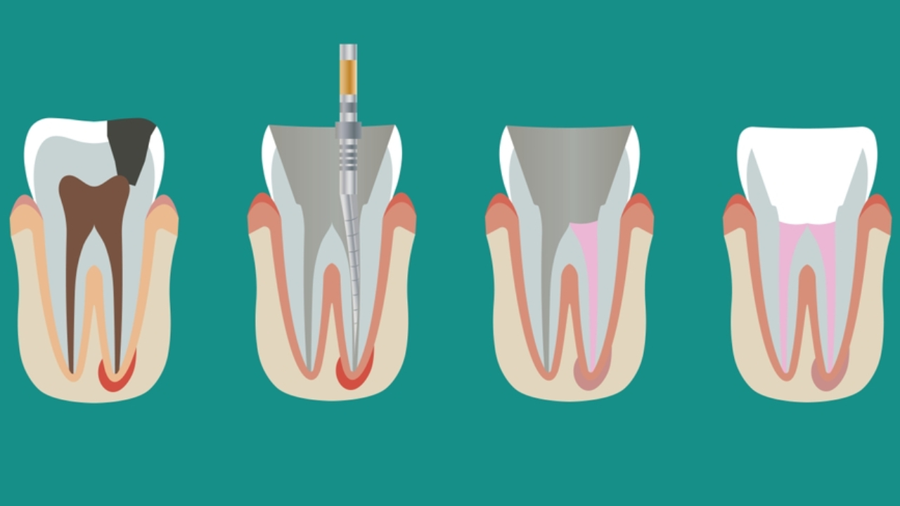 ¿Qué es la endodoncia unirradicular?