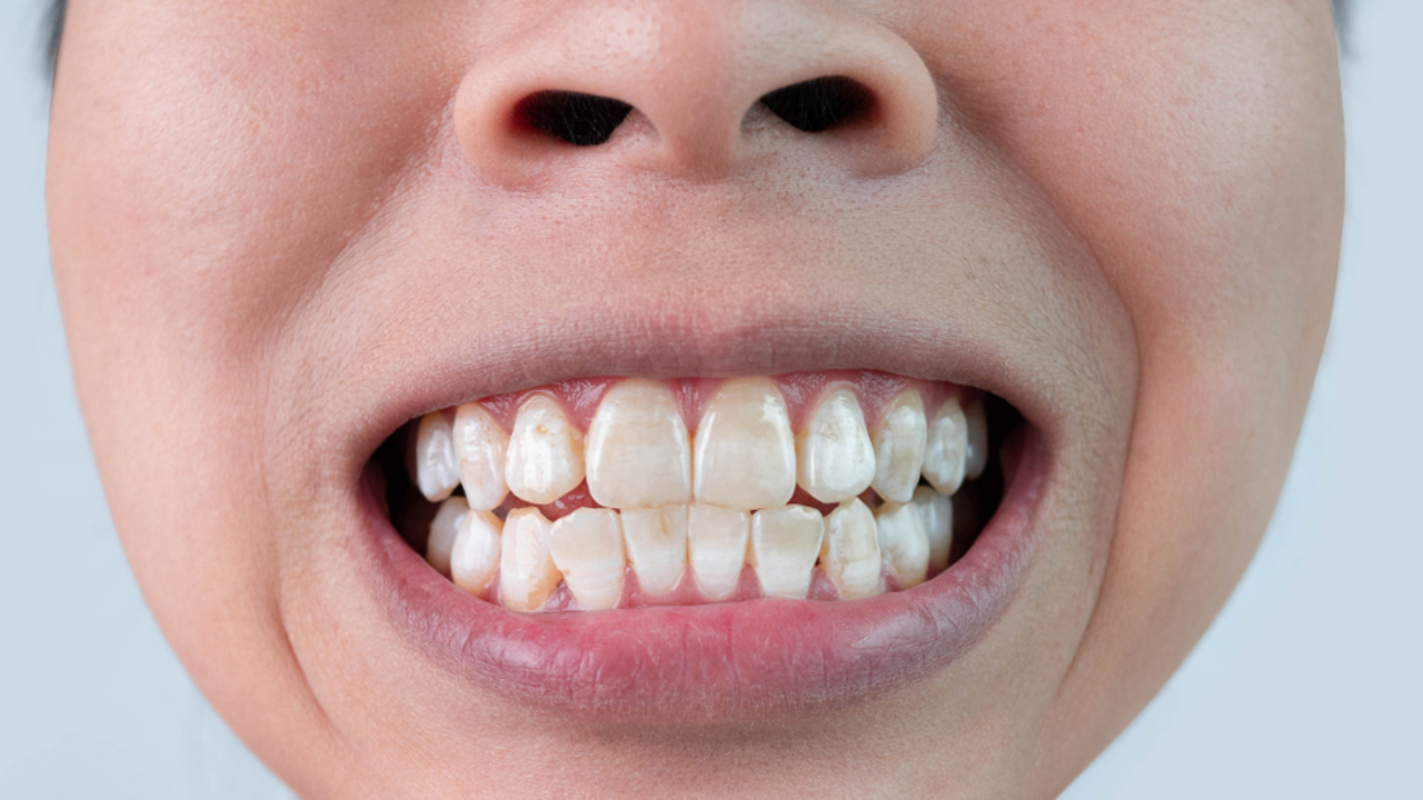 ¿Qué son las manchas blancas en los dientes?