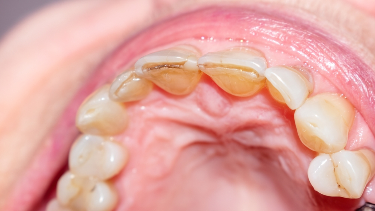 Causas del desgaste del esmalte dental