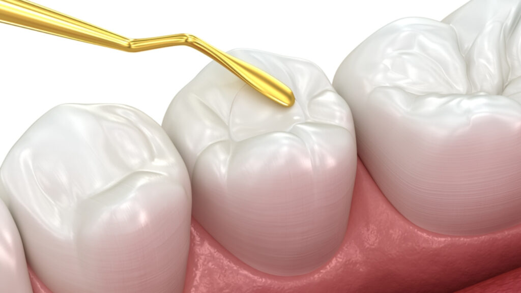 Dolor por empaste dental: causas y soluciones efectivas