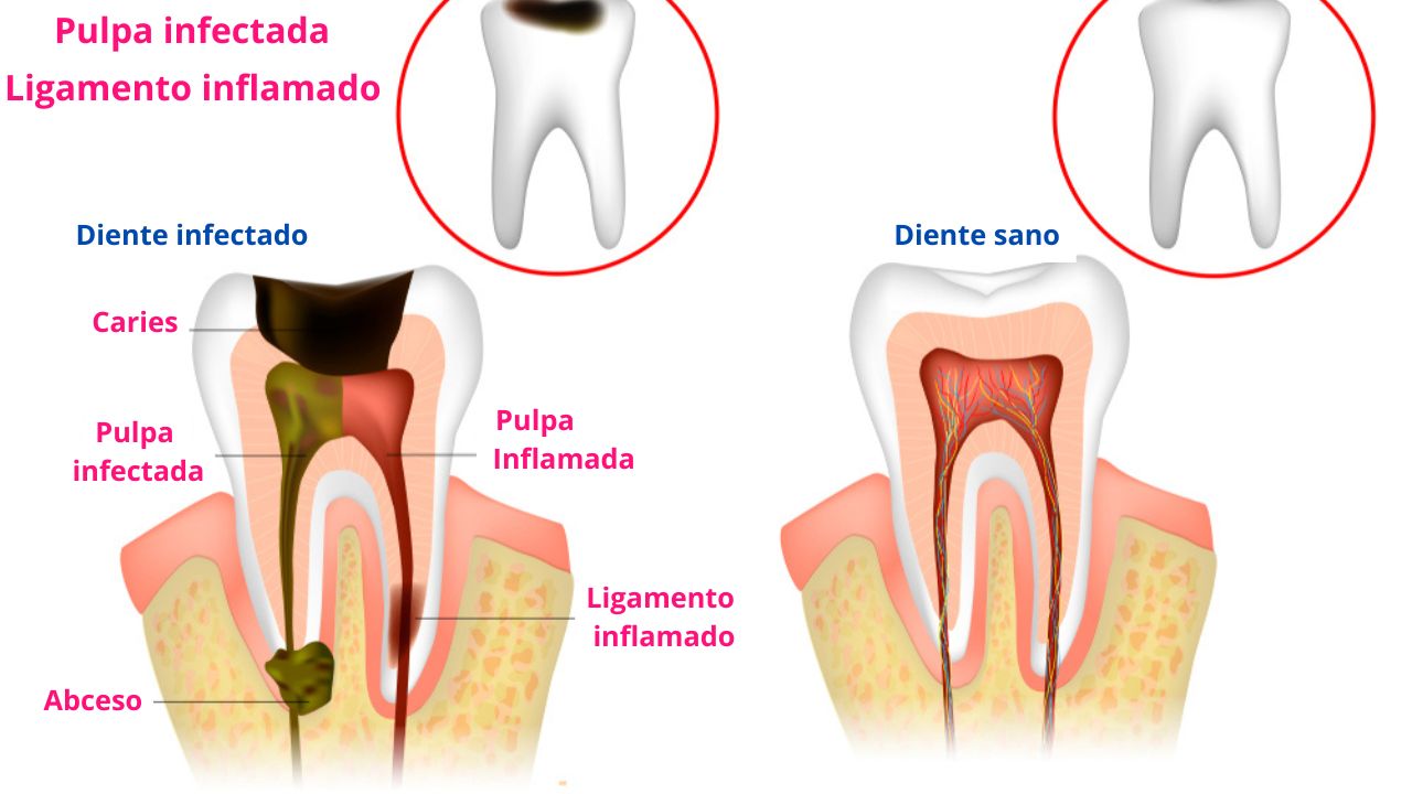Dolor por infección tras empaste dental