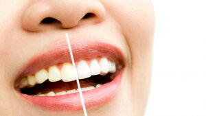 Opiniones del blanqueamiento dental ¿qué dicen pacientes y especialistas?