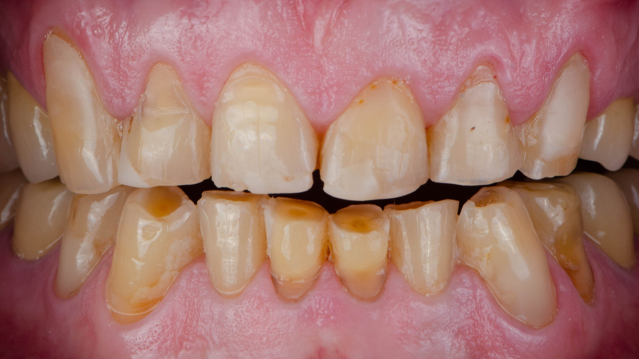 ¿Cómo identificar el esmalte dental desgastado?