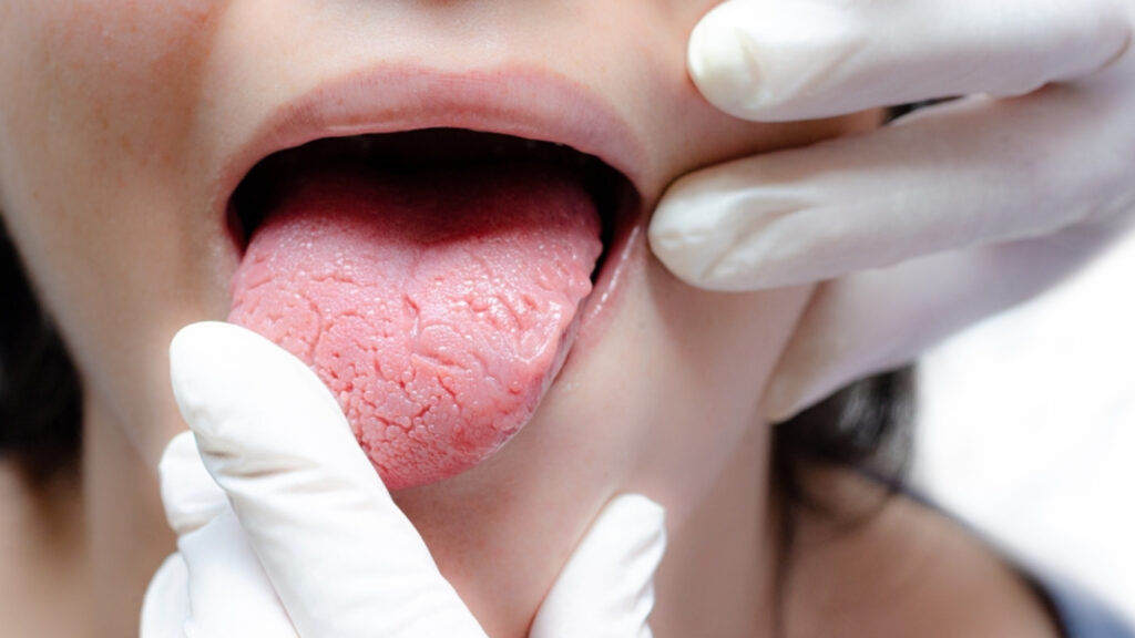 7 enfermedades de la lengua más comunes y cómo curarlas