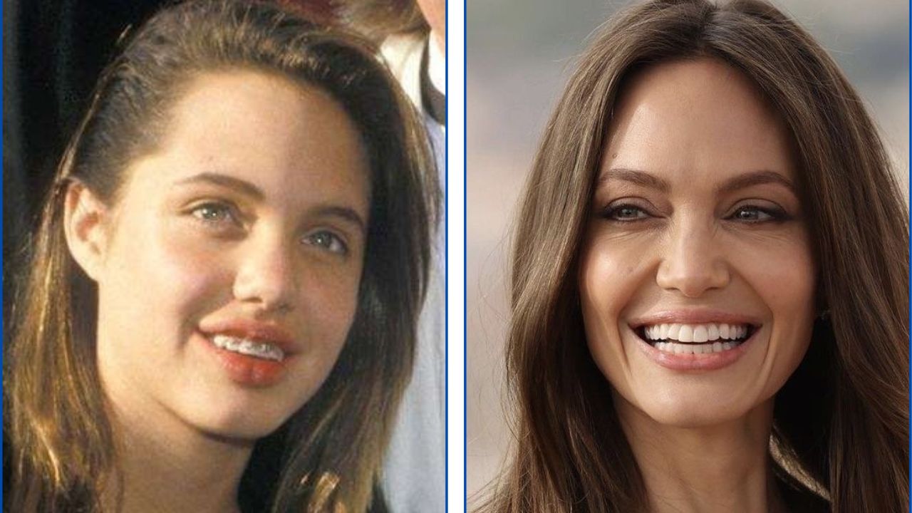 Angelina Jolie con ortodoncia antes y después