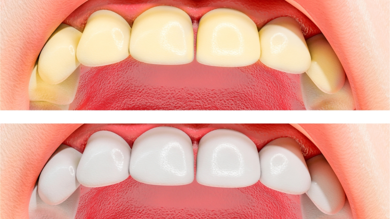 Blanqueamiento dental