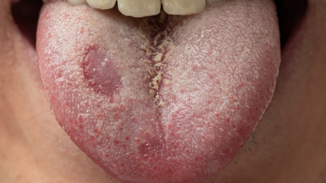 Candidiasis oral