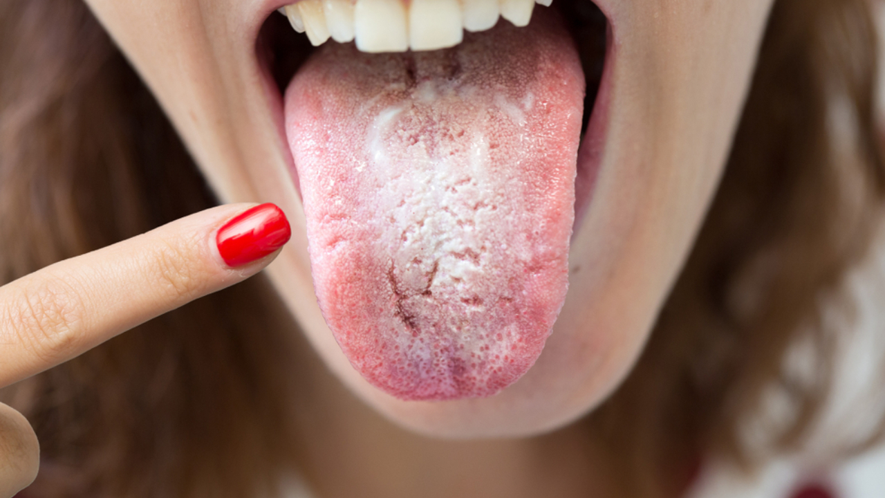 Candidiasis oral