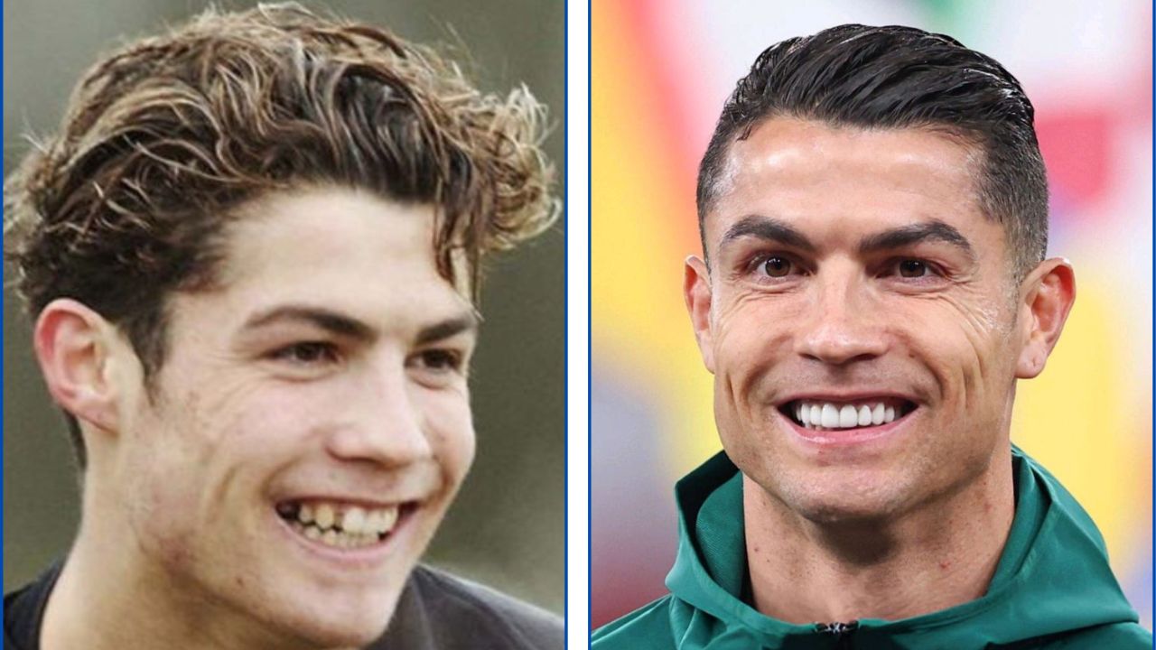 Cristiano Ronaldo con ortodoncia antes y después