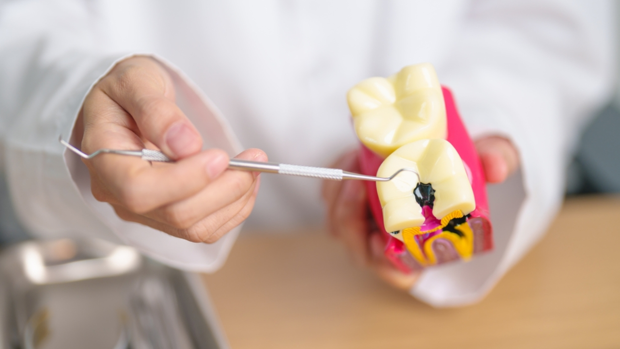 Dientes con caries