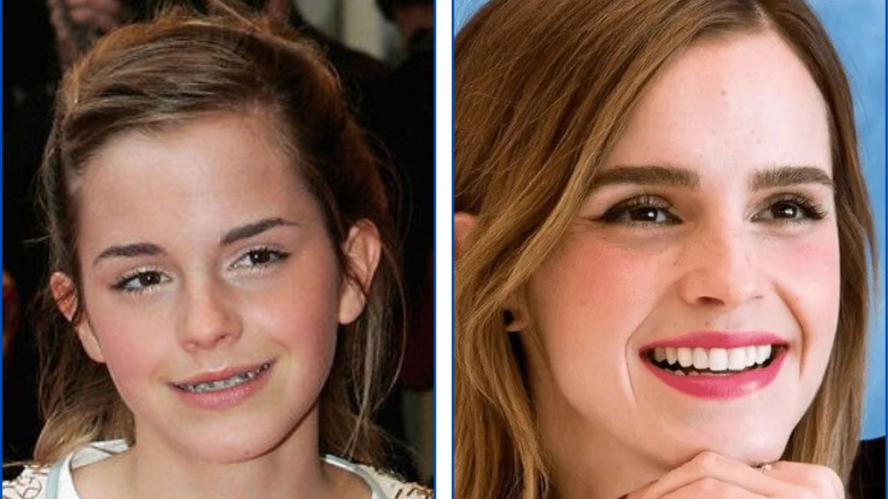 Emma Watson con ortodoncia antes y después