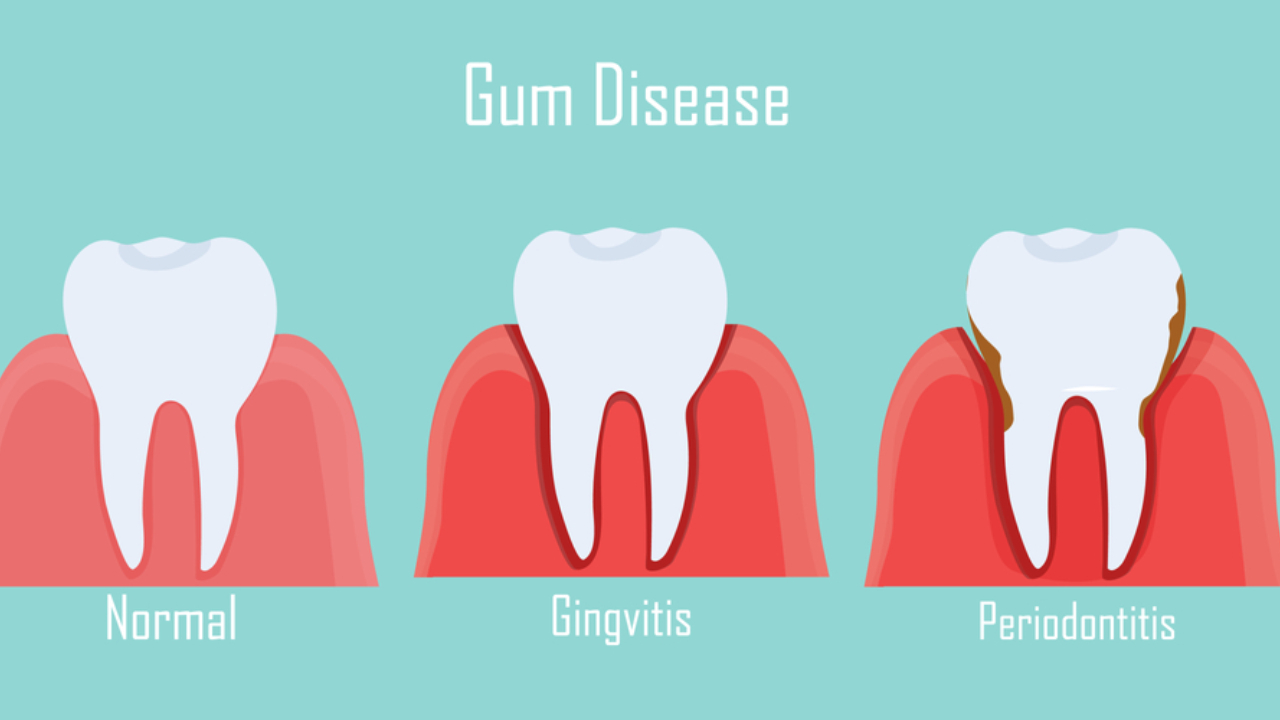 Enfermedades periodontales