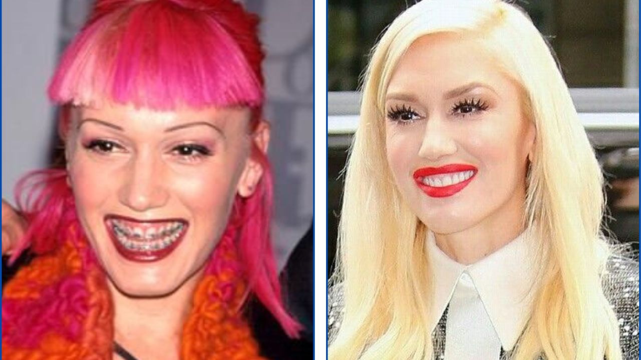 Gwen Stefani con ortodoncia antes y después