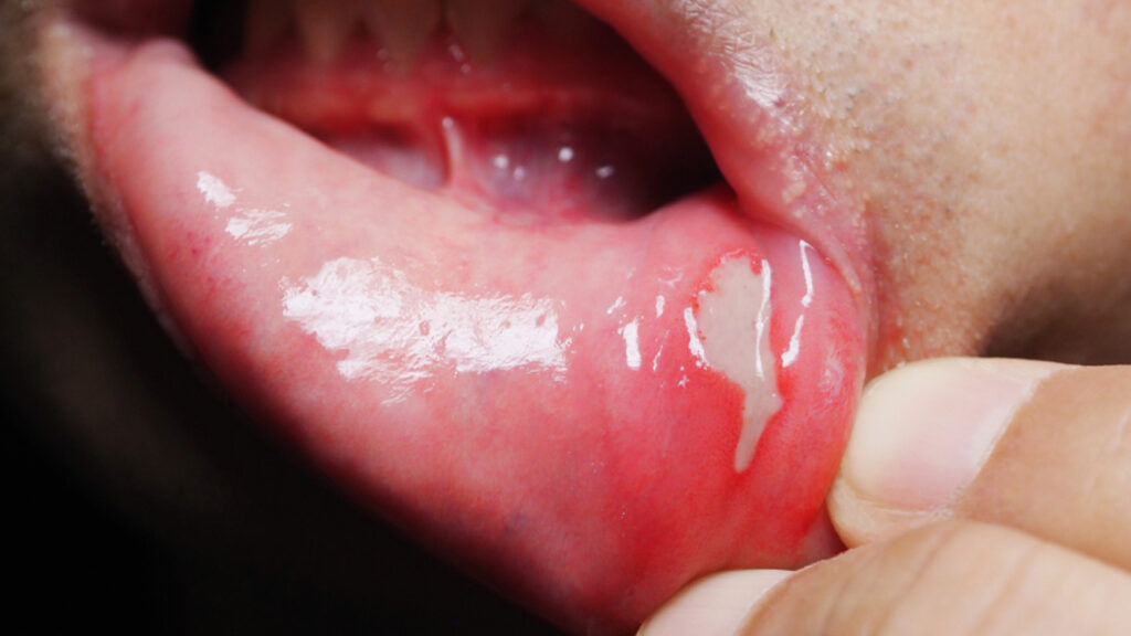7-enfermedades-de-la-lengua-m-s-comunes-y-c-mo-curarlas