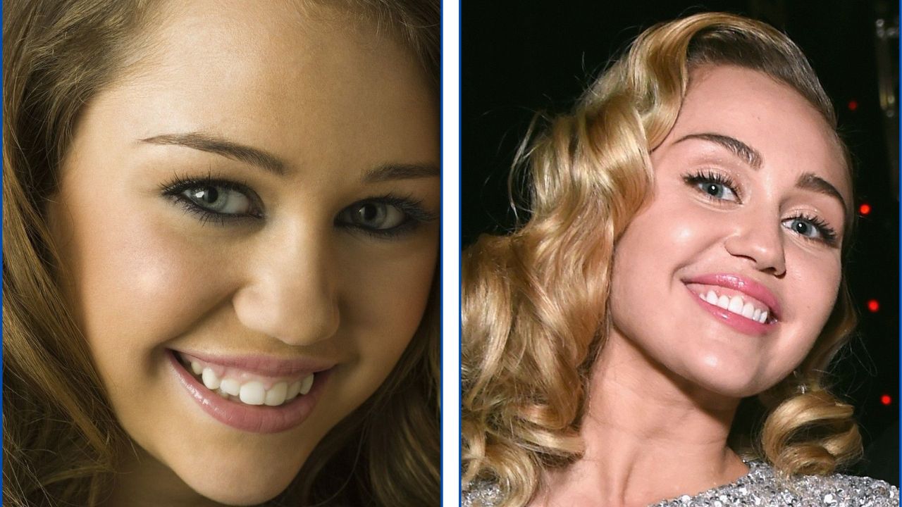Miley Cyrus con ortodoncia antes y después